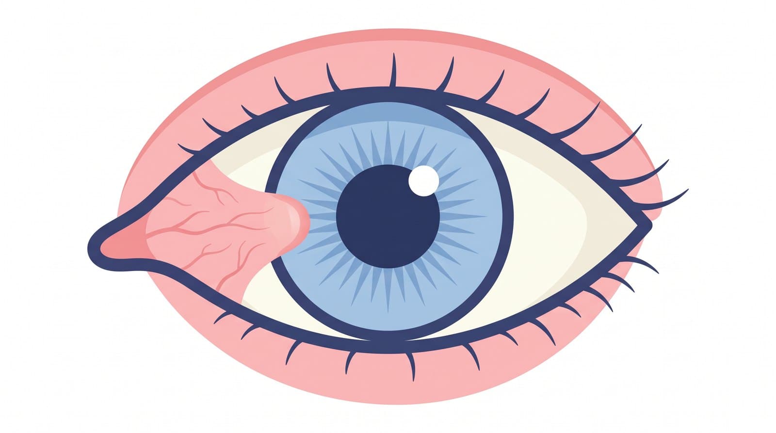 Dibujo de un ojo de frente: una carnosidad crece desde la parte blanca hacia la córnea